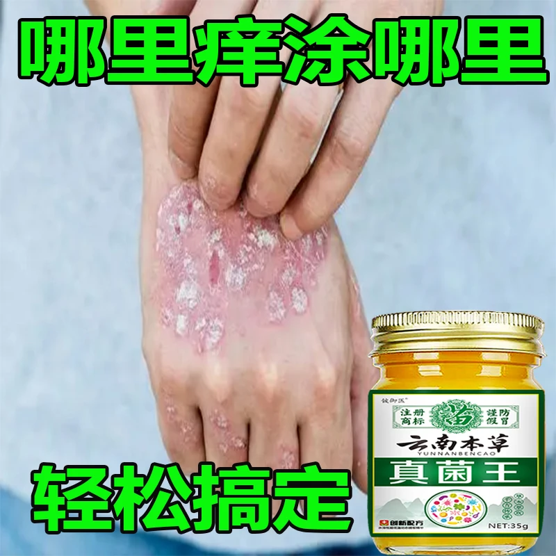 【用了都说好】牛皮肤银屑膏头藓顽固手足股止痒大腿内侧痒全身可用