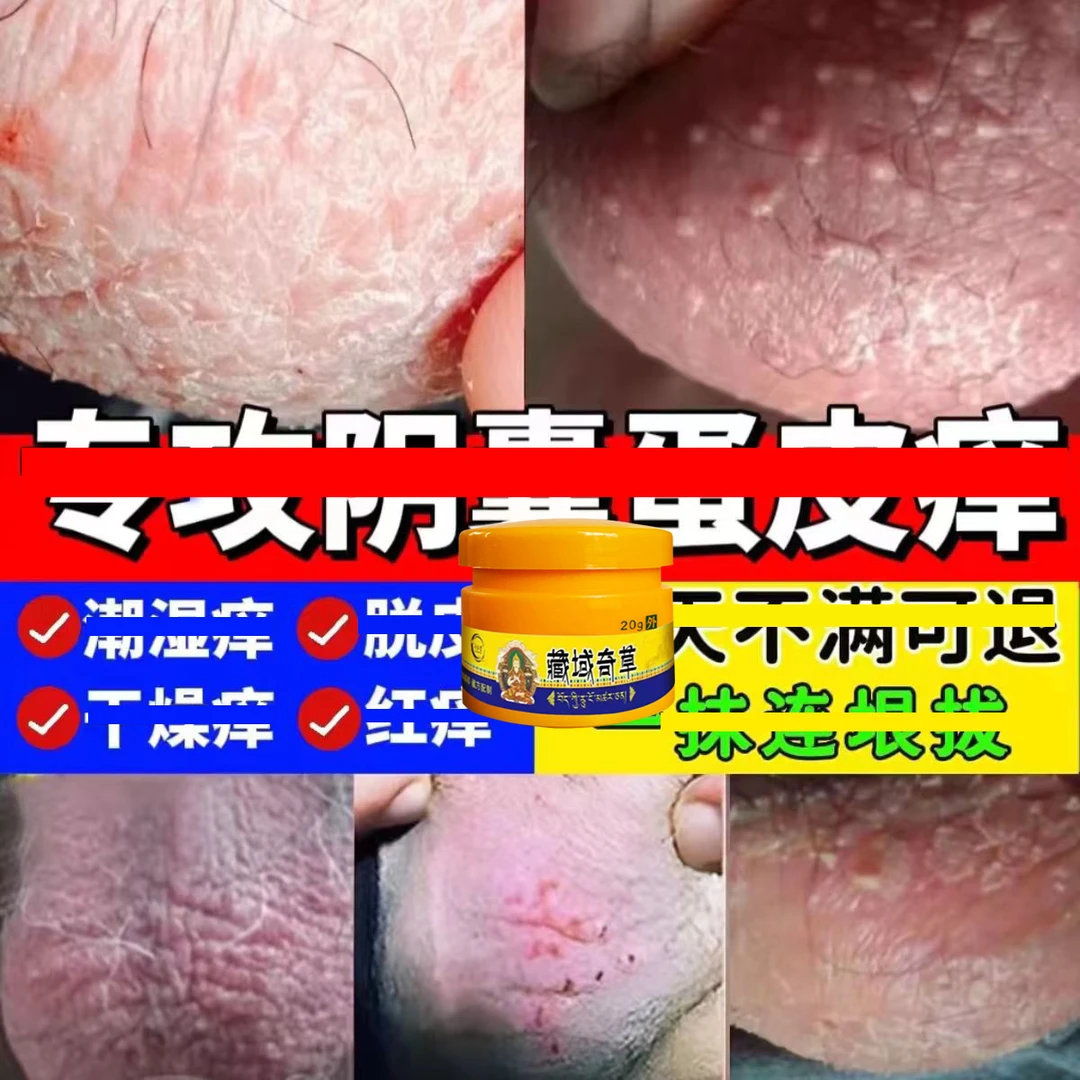男人私处蛋蛋痒阴部潮湿下体大腿内侧痒起乌龟皮疙瘩痒抑菌止痒膏