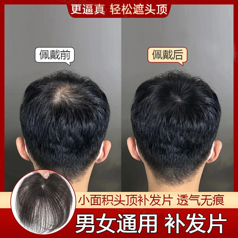 假发片男士头顶补发遮盖头旋发缝斑秃伤疤脱发稀少全真发男女可用