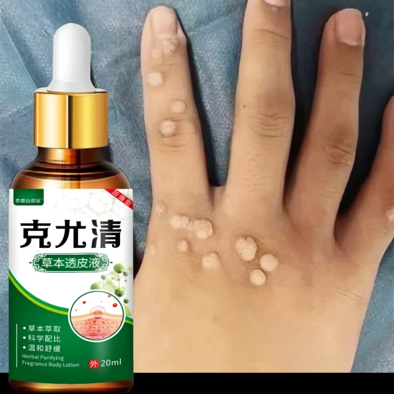 手背小肉刺手上扁平疙瘩肉刺球肉钉疙瘩手足寻常疙瘩温和液p身体
