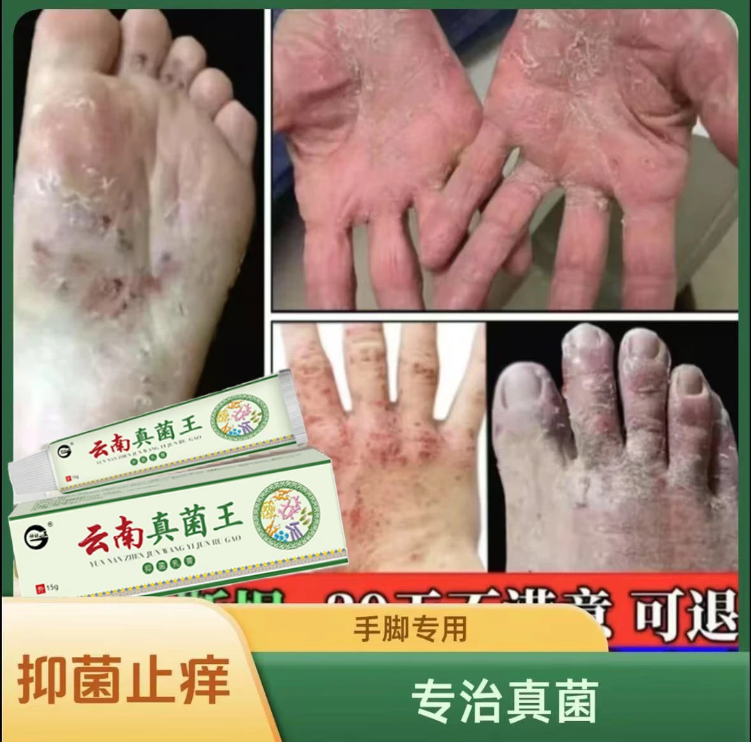 脚底脚上起小水泡又痒又脱皮脚臭气止痒真菌感染草本抑菌克星神器