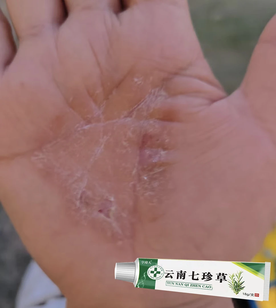 鹅掌风手足脱皮膏【效果才是硬道理】干裂脱皮手痒手裂口抑菌止痒膏