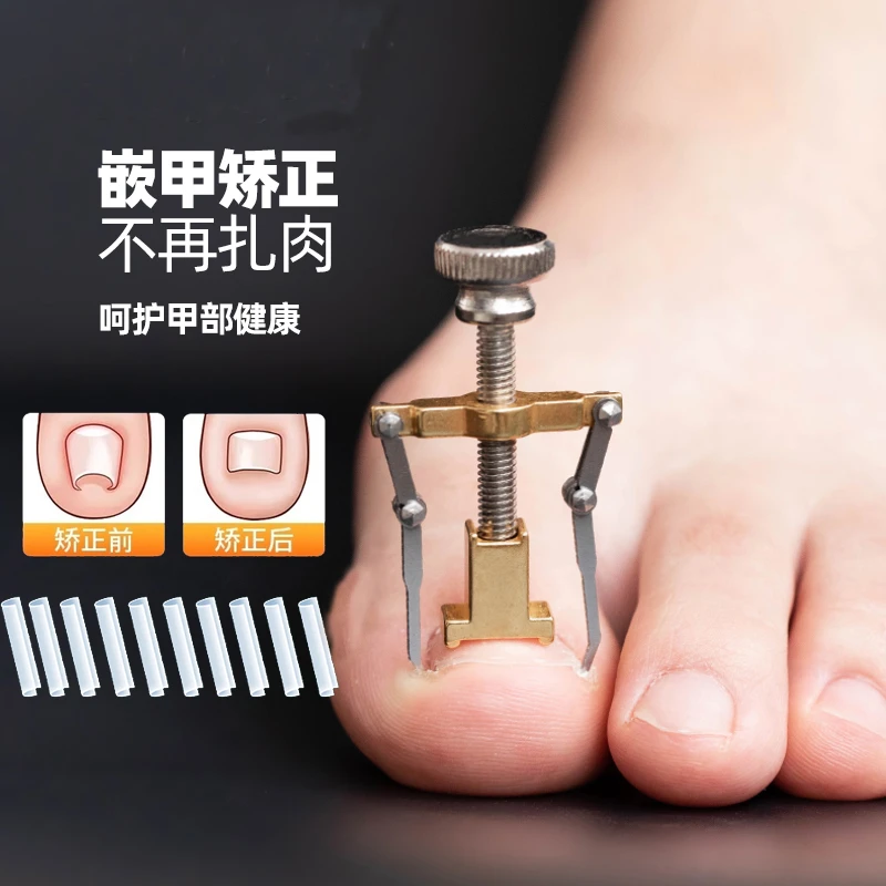 甲沟炎矫正神器嵌甲纠正器隔离填充垫片脚指甲往肉里长怎么办专用
