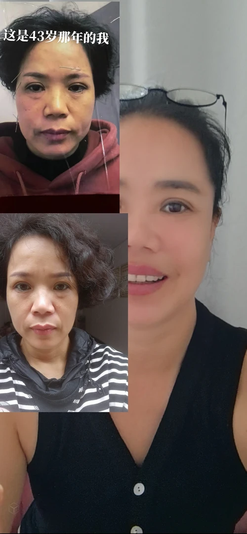 一根针美容不填充