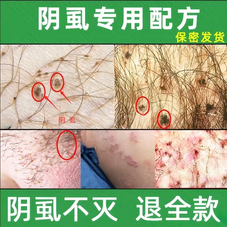 百部酊去虱净男士女士阴用去除阴虱子虱卵去除又快又简单的办法