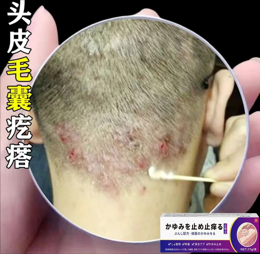日本止痒膏头皮痒毛囊红疙瘩脓包痘痘抑菌止痒个人护理平替好物