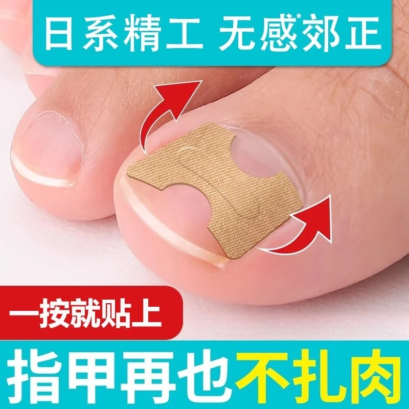 甲沟炎矫正神器正甲贴片脚指甲往肉里长专用隔离垫片脚趾甲矫正器