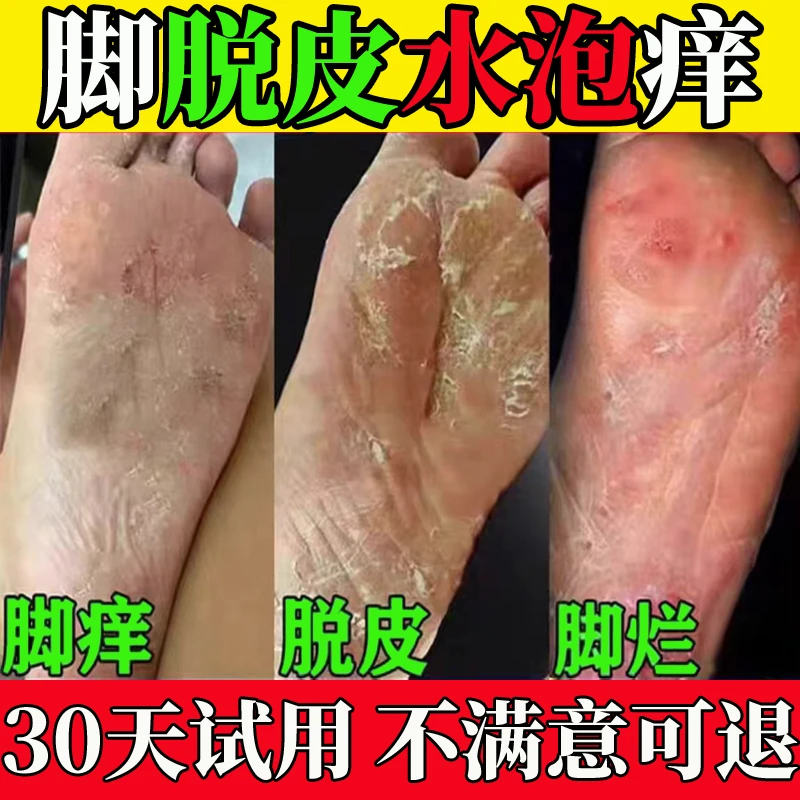 脚痒脚臭止痒膏去脚出汗脱皮起水泡干裂脚趾缝痒喷剂抑菌止痒神器