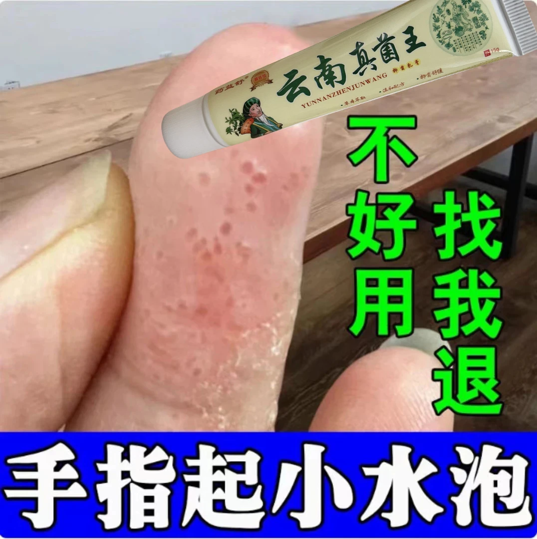 手上起小水·泡汗状水·泡痒手指脱皮专用手足脱皮抑菌膏