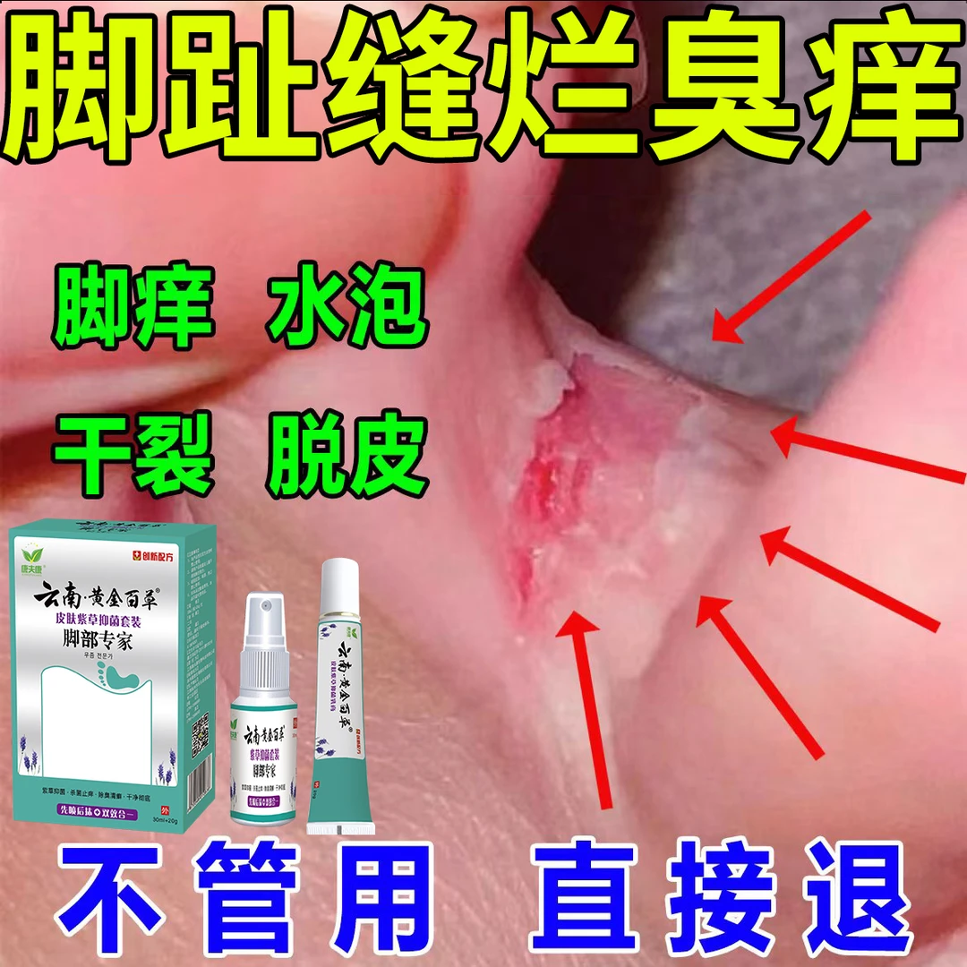 脚趾缝烂臭痒专用止痒膏脚脱皮水泡抑菌止痒神器足部正品草本套装