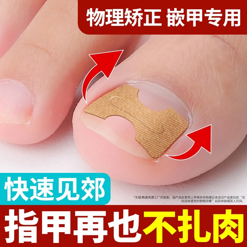 正甲贴甲沟矫正神器炎嵌甲卷甲纠正大脚指甲往肉里长隔离填充垫片