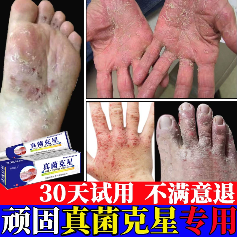 真菌王止痒膏手足真菌感染手脚脱皮臭干裂气瘙痒手部真菌克星喷剂
