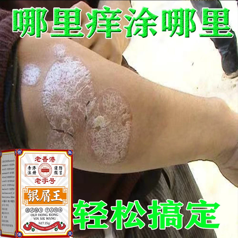 【香港银屑王】银屑王去痒拔毒百草膏牛皮痒全身手足痒外用抑菌膏