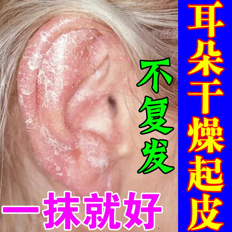 耳朵痒止痒抑菌软膏耳痒耳朵瘙痒起皮掉屑干燥起皮烂流脓水止痒膏