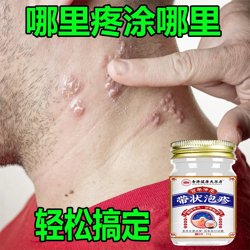 【用了都说好】带状泡疹后遗神经痛蛇盘疮膏带状疱疹后遗症神经痛