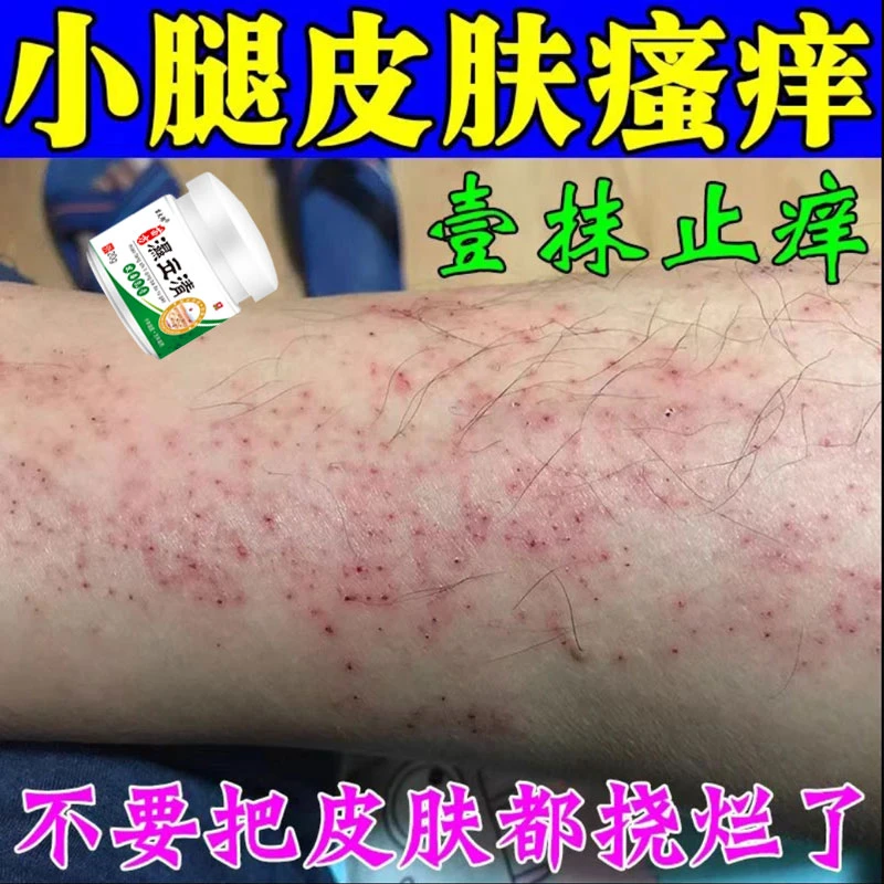 皮肤湿痒季节性瘙痒热痒止痒全身皮肤湿痒干燥起皮痒外用草本乳膏