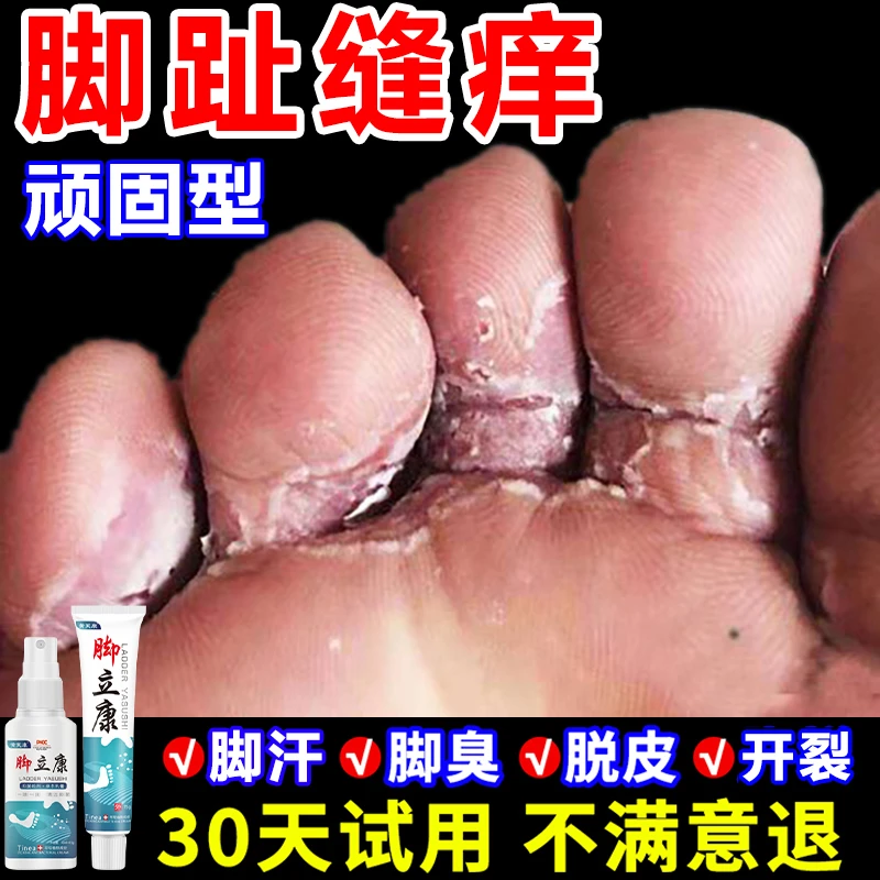 脚趾缝臭痒专用抑菌止痒膏脚痒干裂脱皮汗脚克星水泡外用喷雾剂