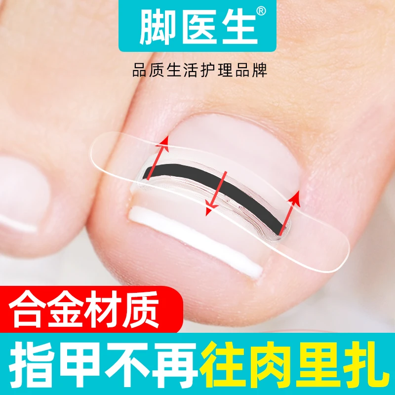 脚医生足部固定器钛合金升级款 嵌甲甲沟炎指甲专用 正甲贴