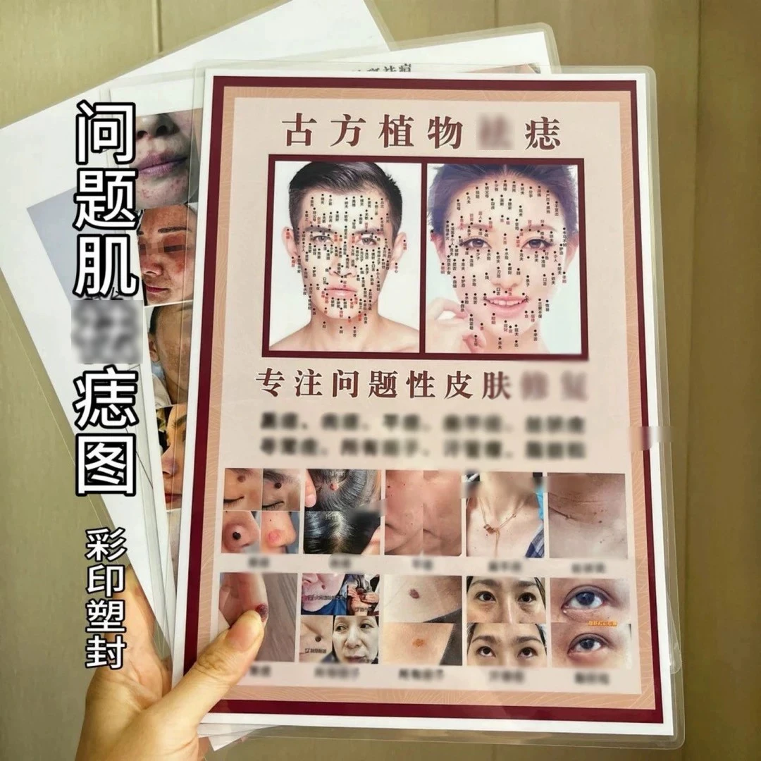 【彩印塑封】2025美业专业相痣图片户外拓客 A4塑封防水彩印图画