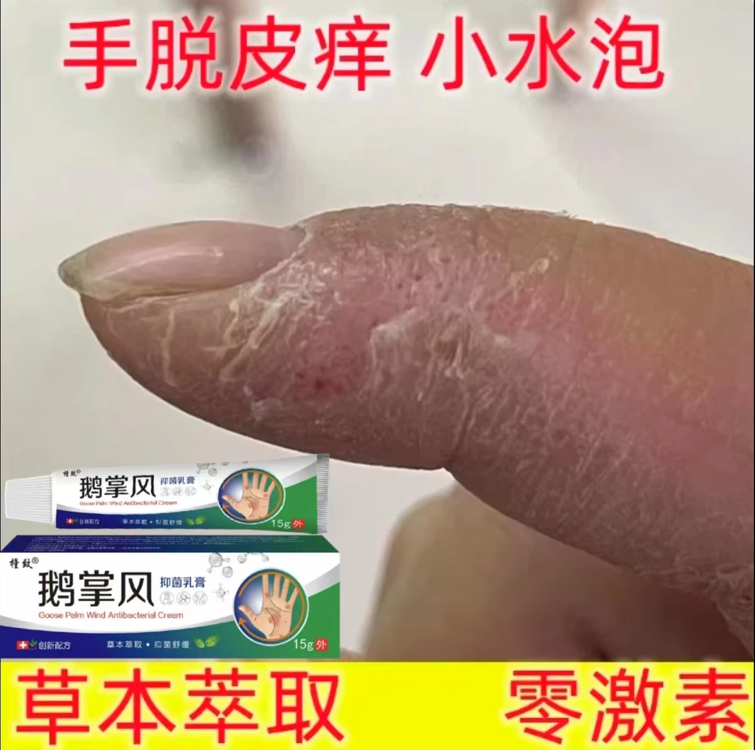鹅掌风手部干裂脱皮手痒手裂口子手足起泡开口开裂百年草本护理膏