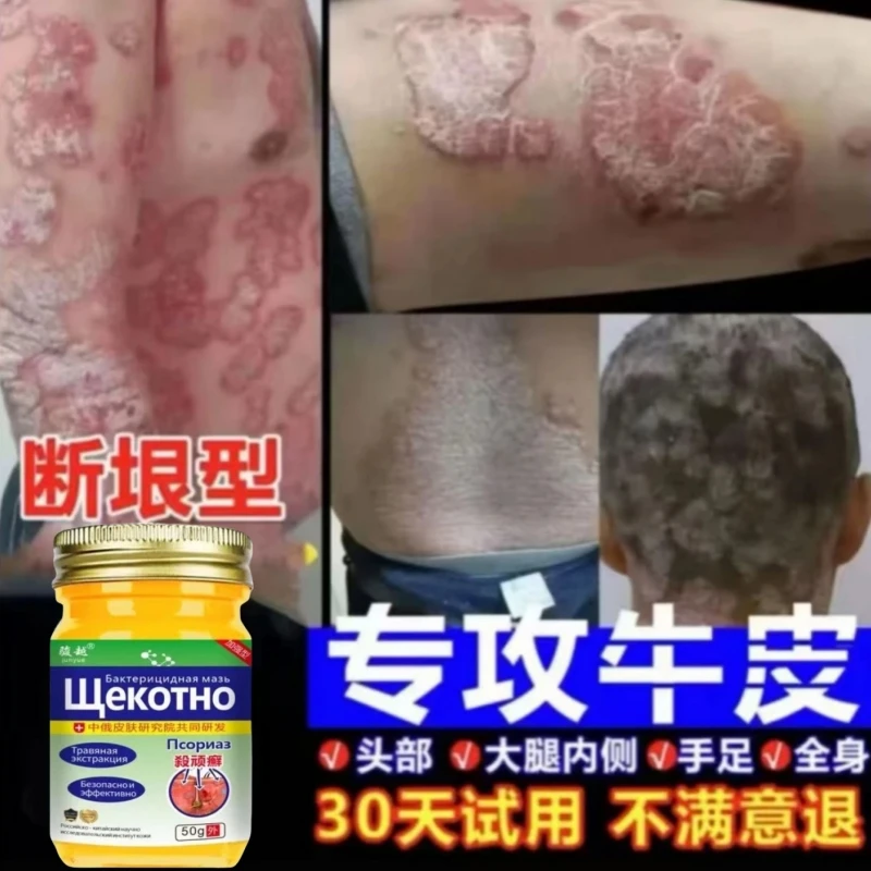 【俄国牛皮膏】全身牛/皮/银/屑/鲜手足头体股大腿内侧草本止痒膏