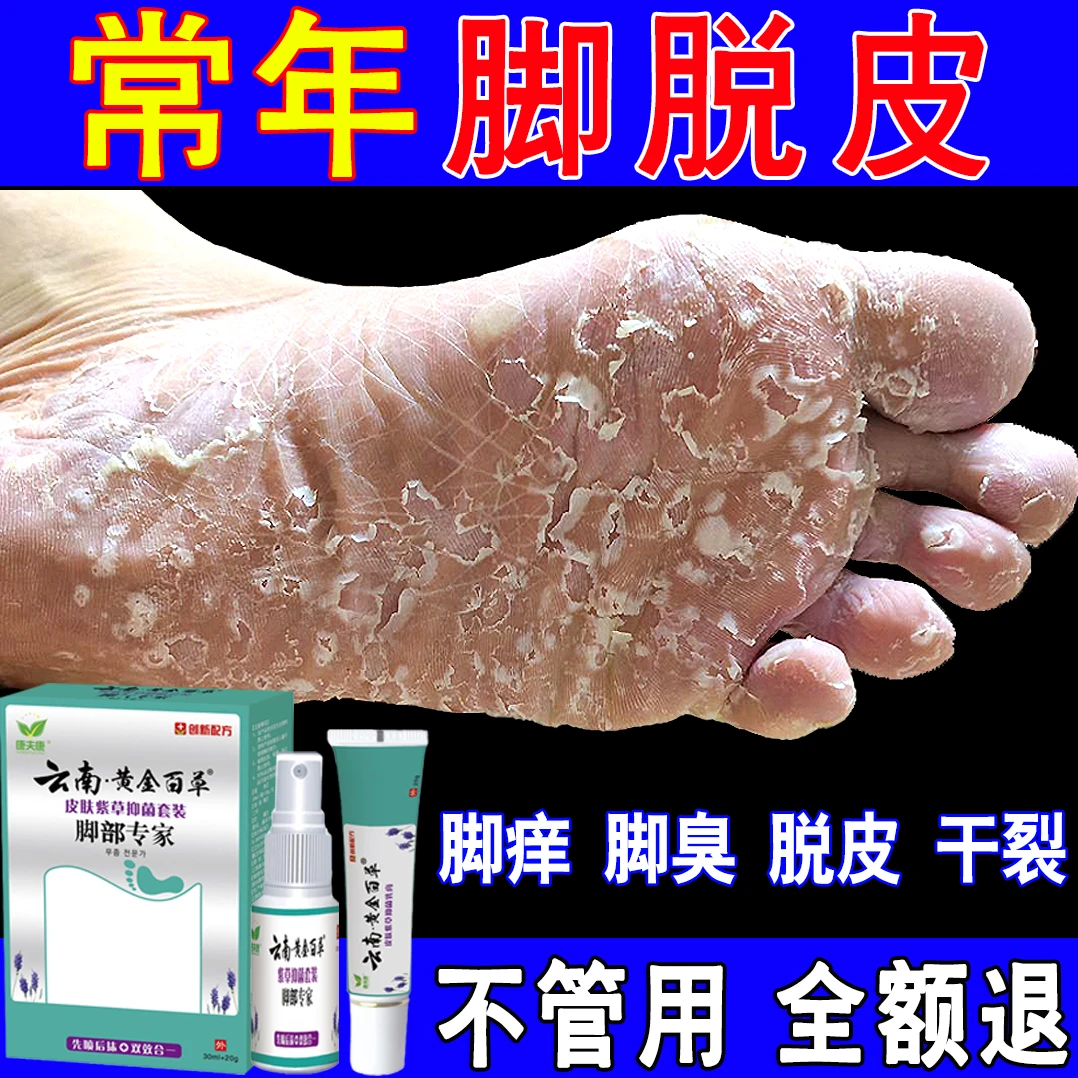 脚脱皮脚痒干裂真菌特效专用膏脚臭喷雾克星止痒神器脚底趾缝脱皮