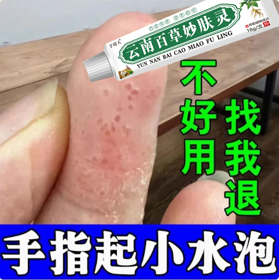手指起小水泡脱皮痒干裂止痒手掌开裂专用克星抑菌正品草本乳膏