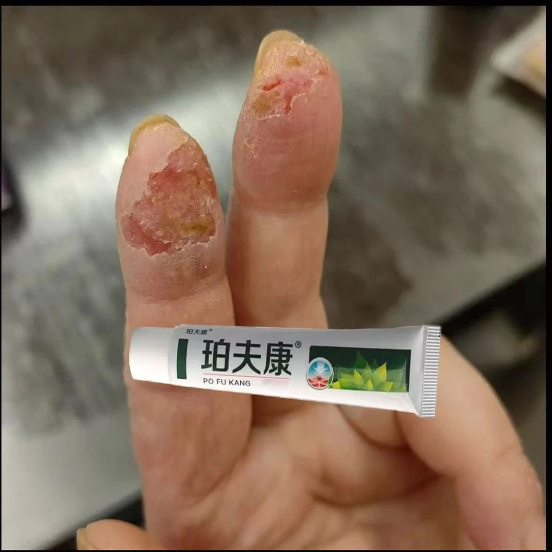手指长小水泡手部痒手足脱皮手指开裂手指脱皮手足起汗泡