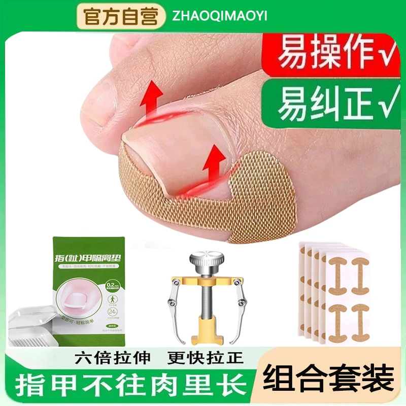 甲沟矫正神器嵌甲矫正贴片指甲往肉里长专用隔离纠正脚趾甲填充垫