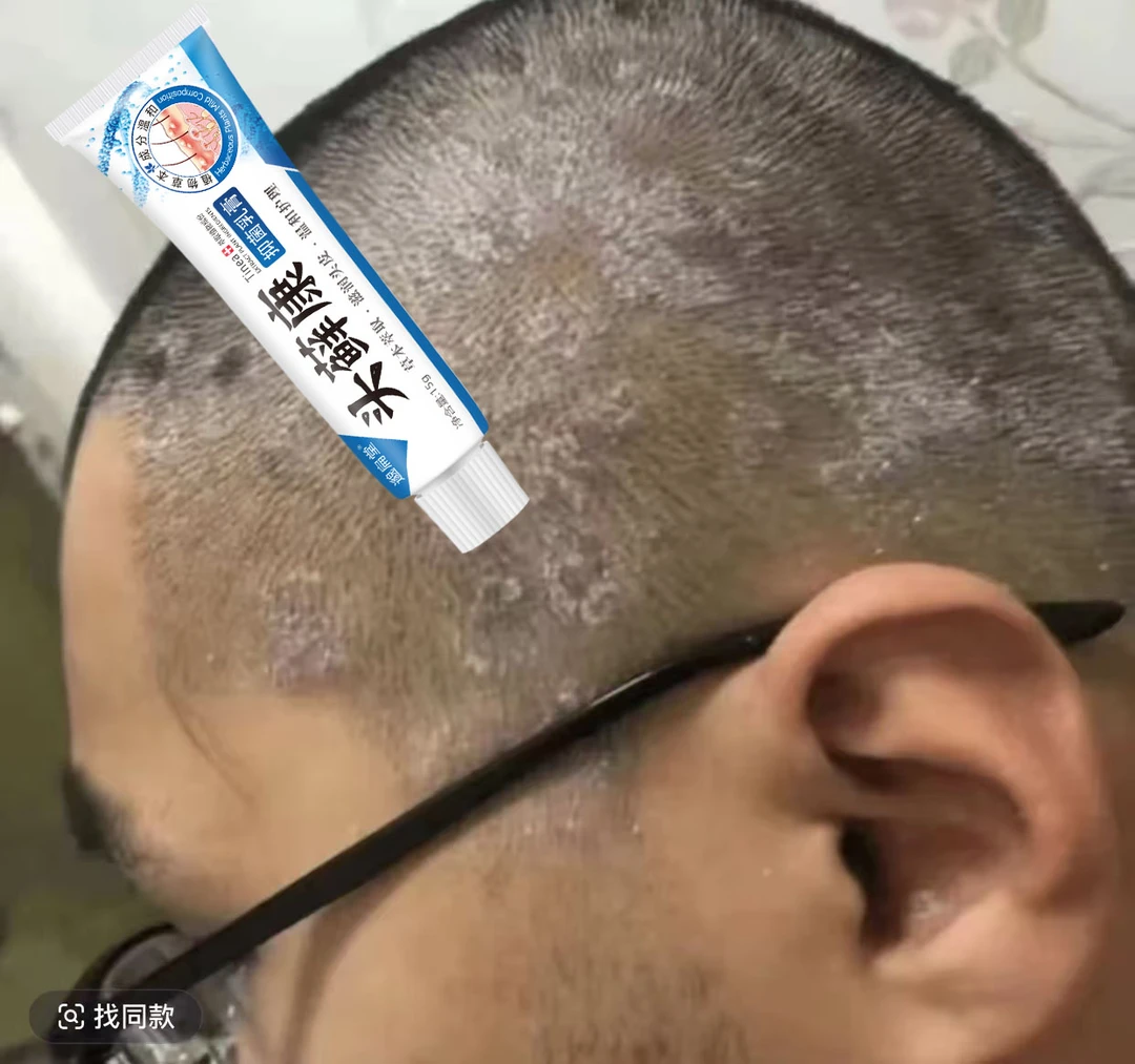 头藓头部痒毛囊头皮抑菌膏头皮痒结痂止痒外用乳膏