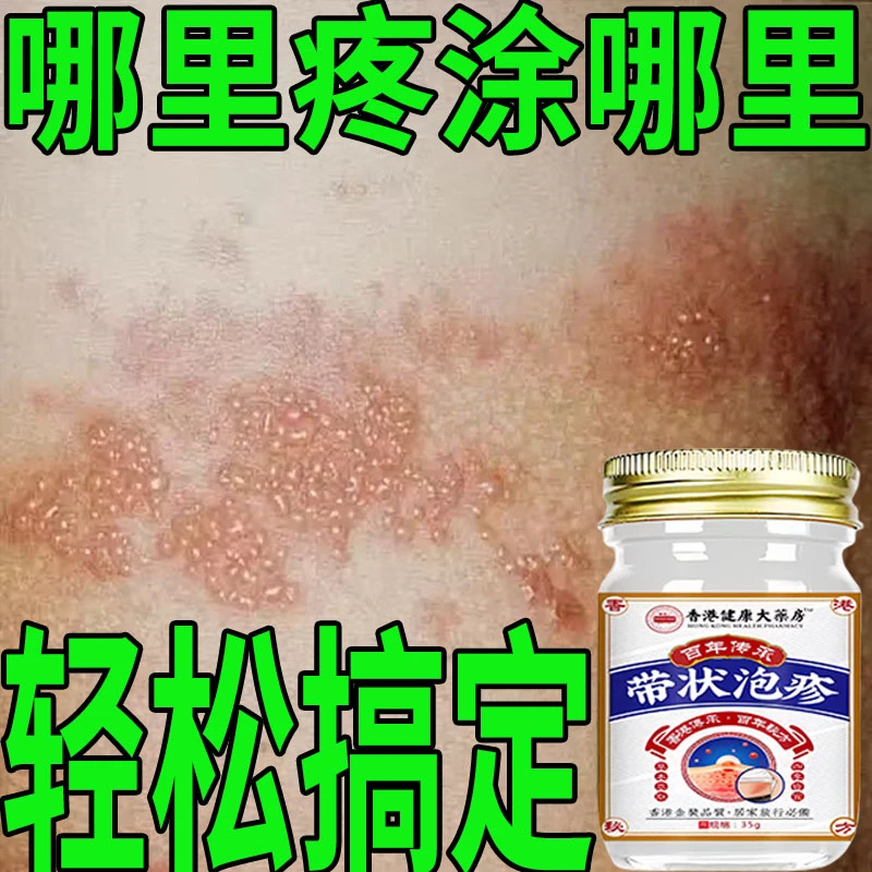 带状泡疹后遗神经痛蛇盘疮膏蛇盘清宝带状疱疹后遗症神经痛特效药