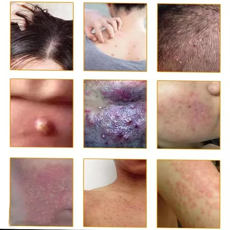 头皮毛囊痘多起皮泛红结痂脓包红痘背部坑坑洼洼红肿毛囊堵塞清膏