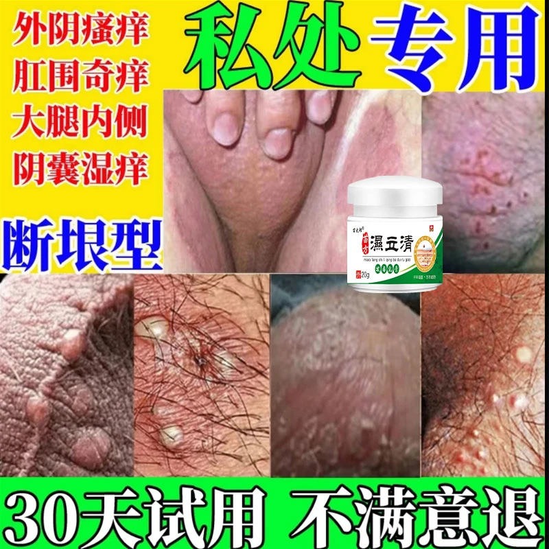 大腿内侧痒去潮湿男士大腿内侧出汗痒大腿内侧发红外用止痒膏