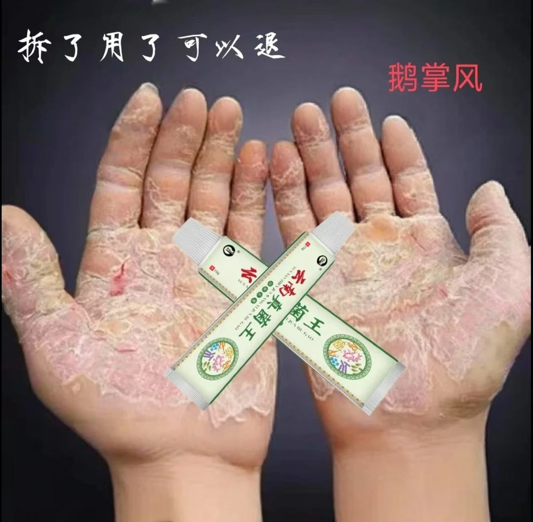 手脱皮手部干裂脱皮手痒手裂口子手足起泡开口开裂起皮草本抑菌膏