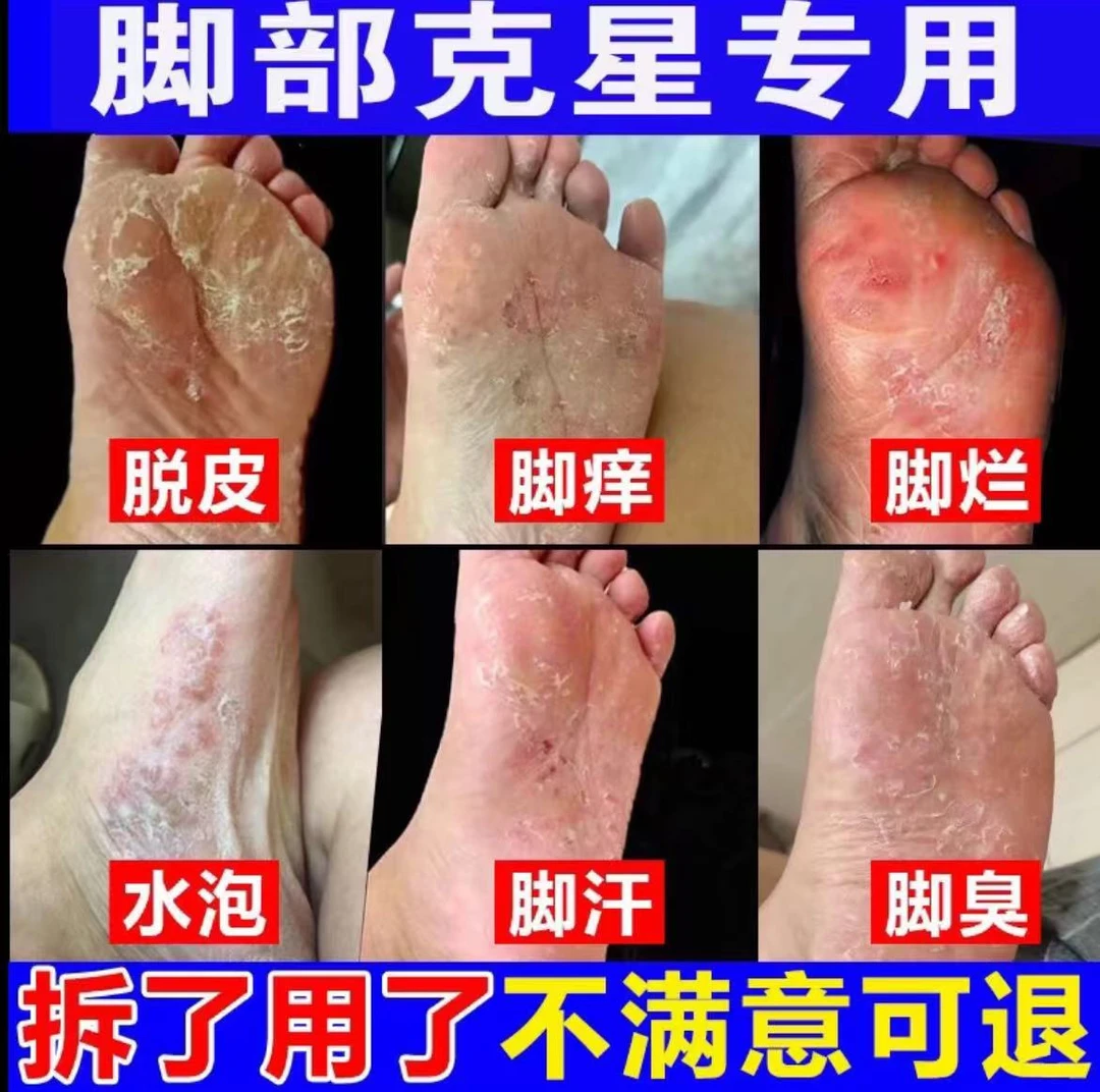 脚痒专用抑菌止痒膏脚臭气干裂脱皮汗脚趾缝痒喷剂克星起水泡