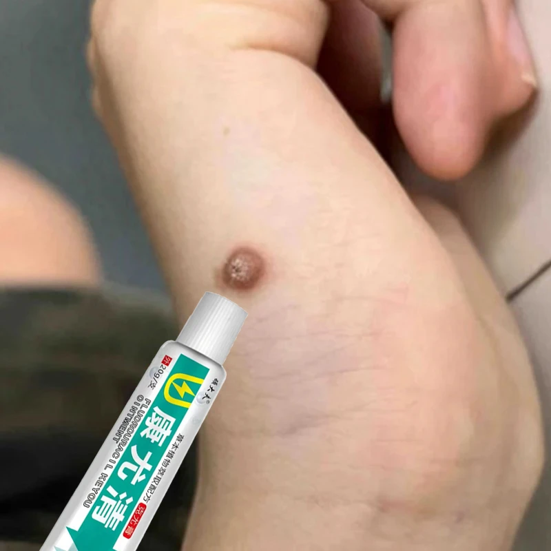 手上长疙瘩刺瘊子手指肉刺球手足凸起寻常疙瘩粗糙肉钉外用膏d