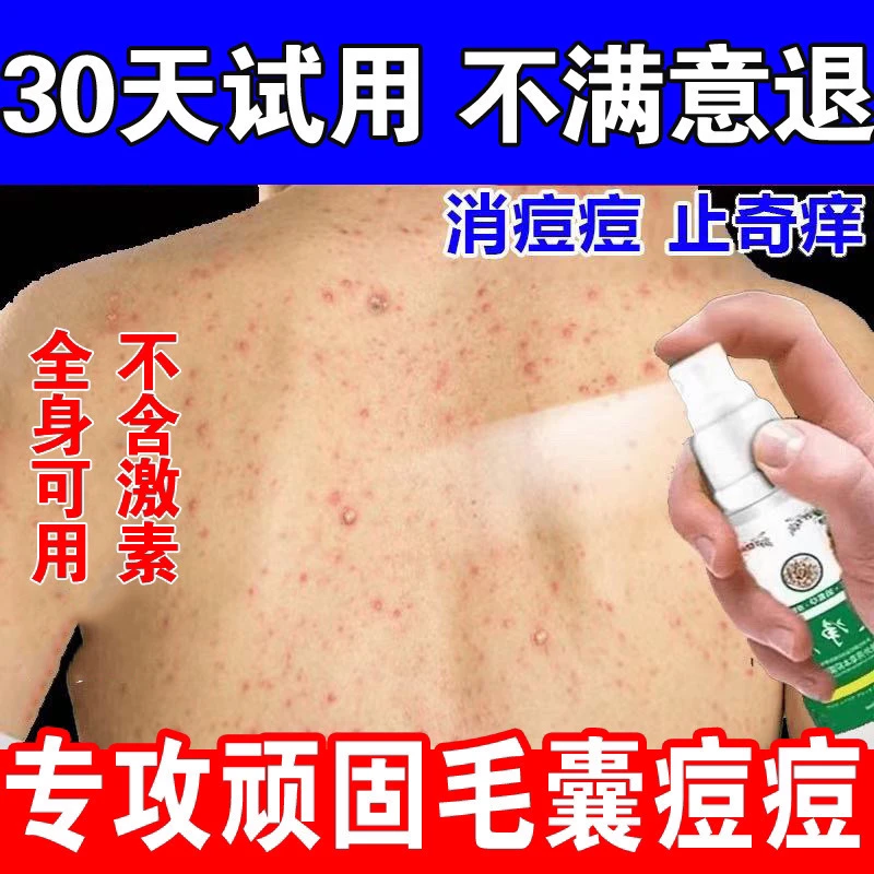 后背毛囊痘背上胸前脖子头皮去除止痒专用软膏皮肤抑菌喷剂神器