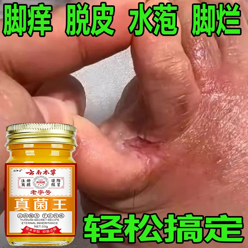 正品真菌王脚痒脚臭脚缝痒脱皮脚底痒脚止痒膏肩颈贴脚部问题适用