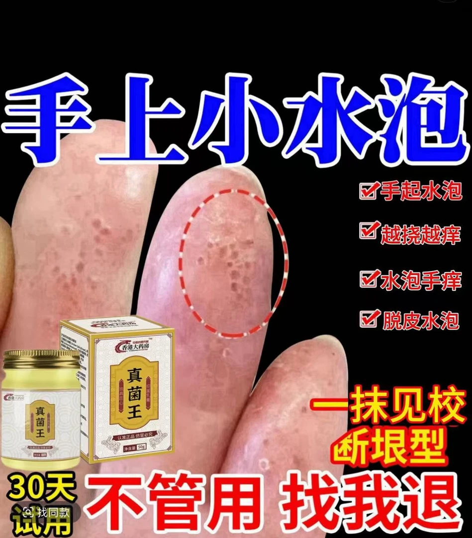 手上起小水泡止痒膏脱皮抑菌克星手指缝痒干裂汗专珍用泡真特剂效