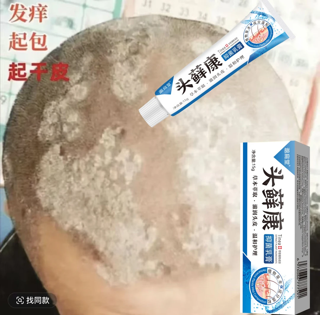 头皮屑多大块白色头皮结痂特效乳膏头皮止痒抑菌专用毛囊红疙瘩乳