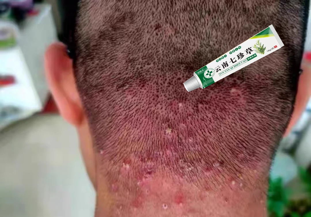 专注头皮毛囊小红痘痘止痒祛疙瘩神器毛囊焱抑菌膏头皮湿毒涂抹膏