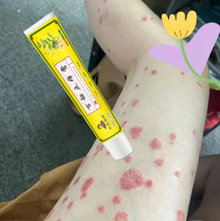 大腿银屑皮肤瘙痒半夜全身湿痒后背痒真菌王神经性皮痒抑菌止痒膏