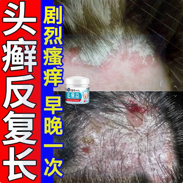 头藓头部痒毛囊头皮屑真菌王抑菌膏头皮痒结痂止痒草本外用乳膏