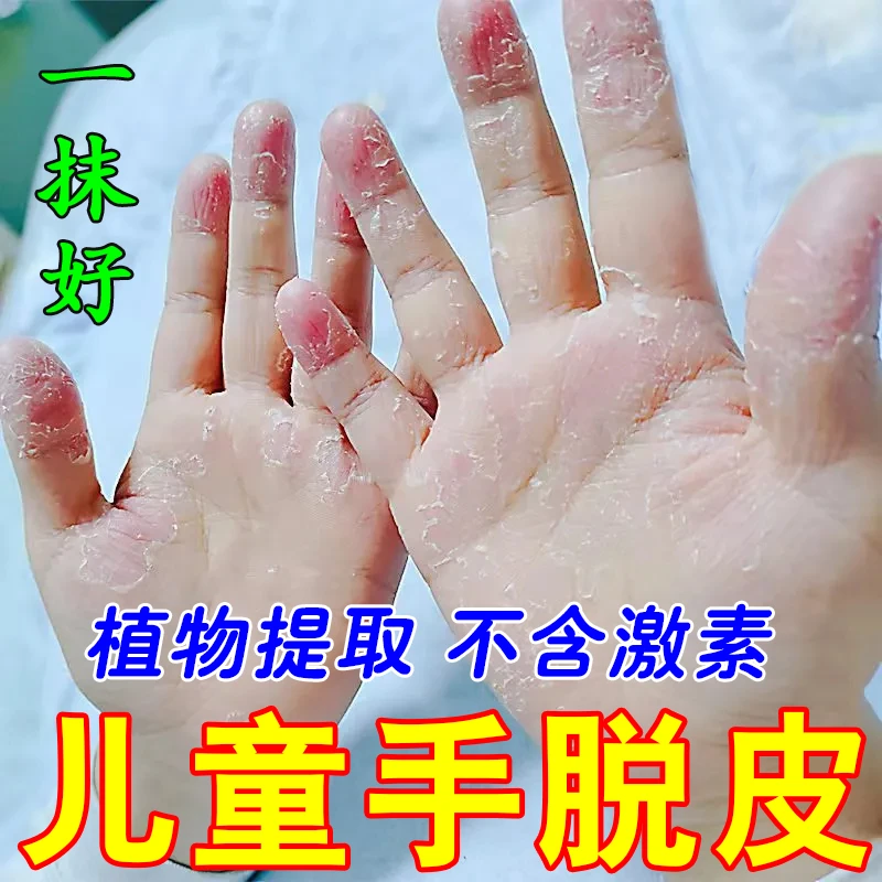 儿童手脱皮手心掉皮手掌粗糙手指头尖尖爆皮手指干裂抑菌软膏