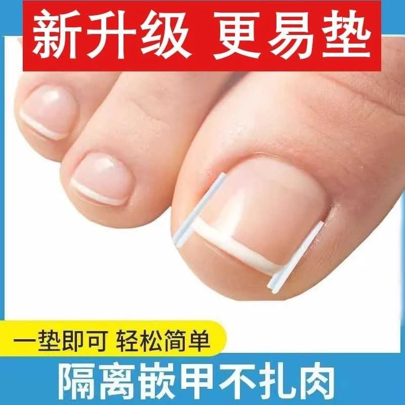甲沟炎矫正神器嵌甲专用脚指甲矫正器趾甲长肉里纠正隔离垫片工具
