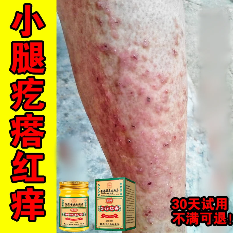 小腿红点疙瘩脱皮渗液干痒腿上身上手上抓痒越抓越痒断痒拔毒膏