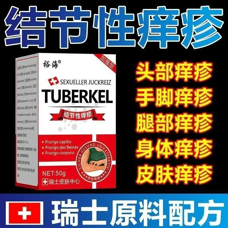结节性痒疹止痒进口去顽固硬疙瘩手脚头部全身结节疙瘩无激素乳膏