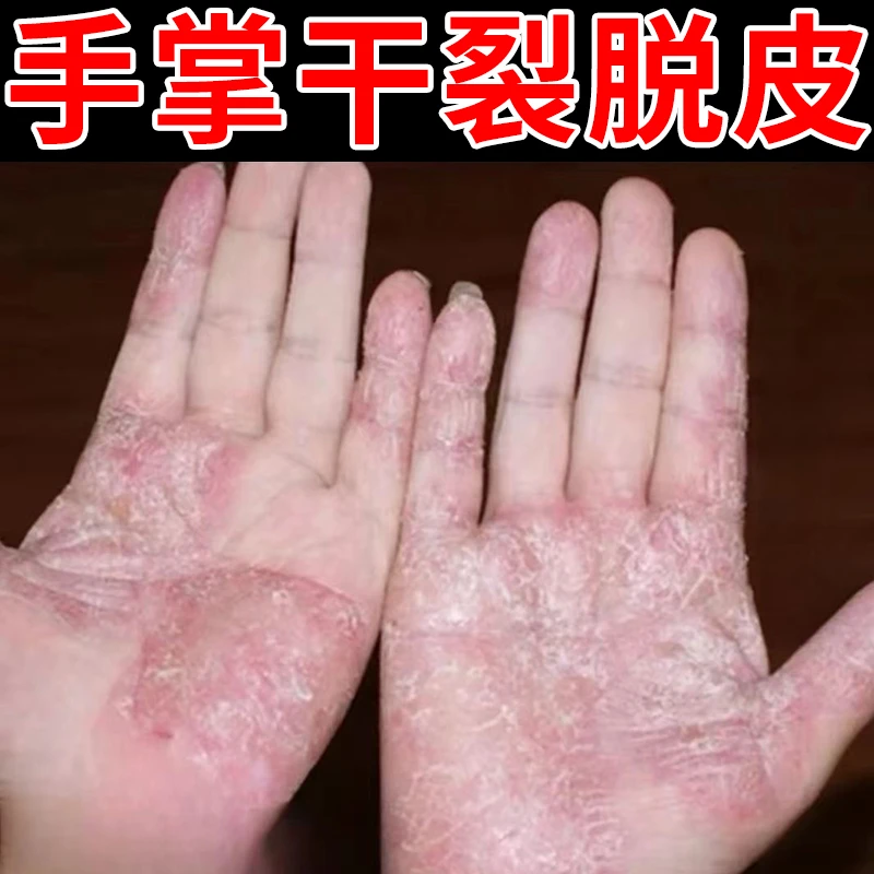 云南本草手足脱皮膏20g/盒 草本萃取涂抹温和外用手脚部脱皮干裂