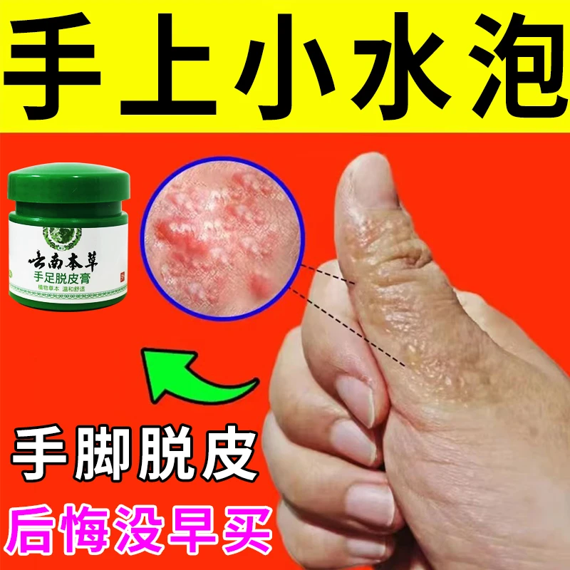云南本草手足脱皮膏20g/盒 草本萃取涂抹温和外用手脚部脱皮干裂
