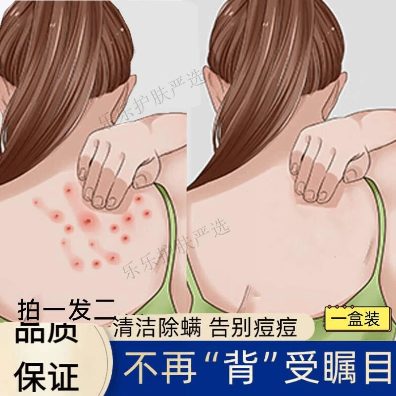 后背祛痘清新喷雾除螨黑头背部胸前脸部身体背上香体快速祛痘痘印